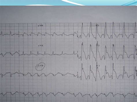 ECG: Bifascicular Block