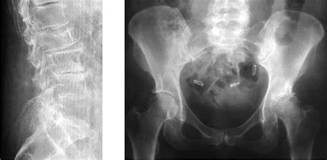 Patient one: Lateral lumbar spine X-ray showing significant ...