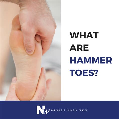 #Hammertoes, #clawtoes and #mallettoes, are toes that have curled into ...