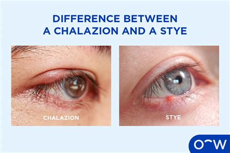 Chalazion: Symptoms, Causes, Diagnosis, and Treatments