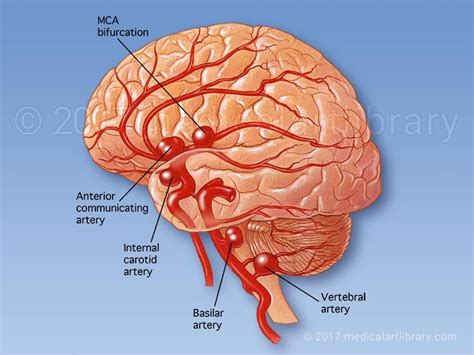 License Image Shown in this illustration are aneurysms of the following ...