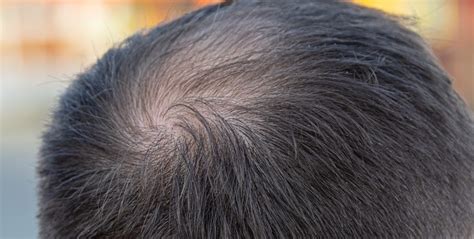 Crown Hair Patch For Thinning Or Balding | ubicaciondepersonas.cdmx.gob.mx