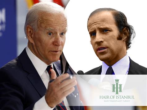 Joe Biden Hair Transplant: A Closer Look at the Evidence