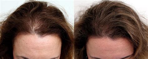 Hair Loss in Women NYC, NY - The Hair Loss Doctors