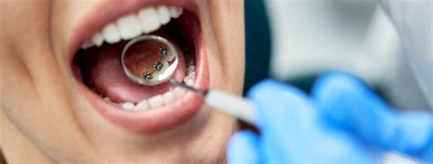 The Advantages and Disadvantages of Lingual Braces – Hockenberger ...