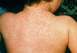 Meningitis Rashes: How to Recognize the Disease (with Pictures)?