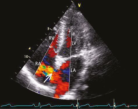 Atrial Septal Defect (ASD) Congenital Heart Disease In, 53% OFF