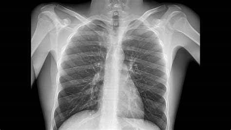 Chest X Ray Pneumonia Vs Bronchitis