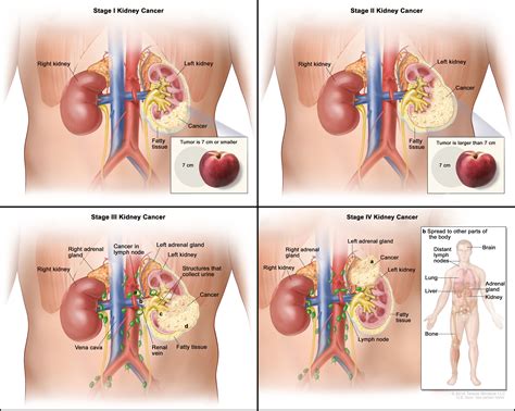 Kidney Cancer | Knight Cancer Institute | OHSU