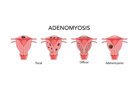 Adenomyosis - Symptoms, Causes, Diagnosis, and Treatments - Freiewebzet.com