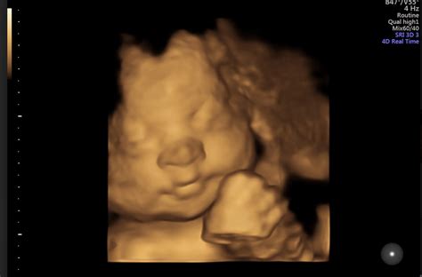 Private Ultrasound Scans London - Private Ultrasound London