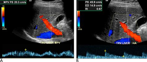 Duplex Doppler Ultrasound of the Hepatic Artery: A Window to ...