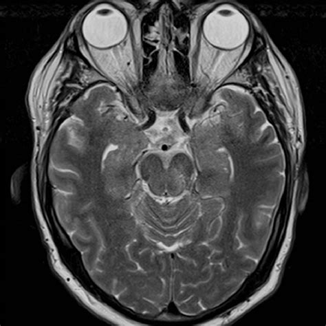 MRI brain showing areas of abnormal enhancement within the basilar ...