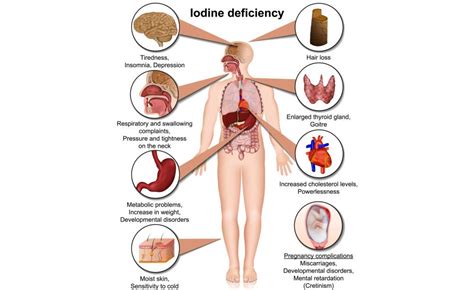 What is iodine deficiency? | Causes, Symptoms & Cure | Birla Hospital