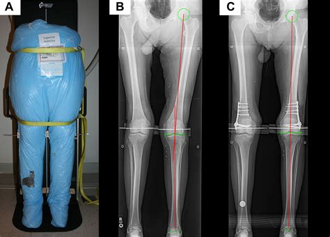 Derotational Osteotomy of the Distal Femur for the Treatment of ...