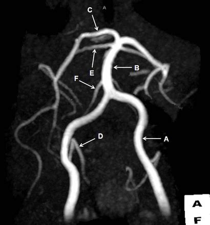 Magnetic resonance angiography of the posterior circulation | The BMJ