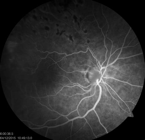 Focal Laser photocoagulation in ischemic peripheral retina in BRVO ...