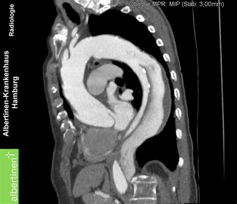 Aortic Dissection CT Scan