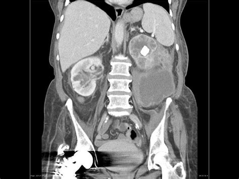 Perinephric abscess imaging