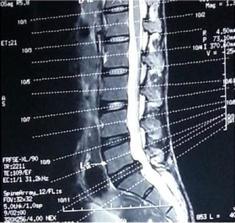 List 100+ Images Mri Images Of Herniated Disc L5-s1 Updated