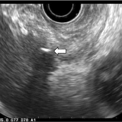 Esophagogastroduodenoscopy (EGD) finding. EGD revealed an ingested ...