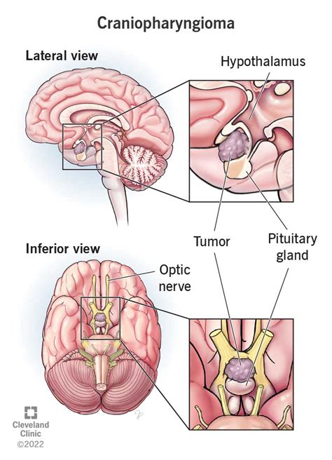 Craniopharyngioma: Definition, Symptoms, Causes & Treatment