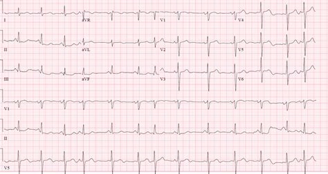 60-Year-Old Man With Skipped Heartbeat, Shortness of Breath and Light ...