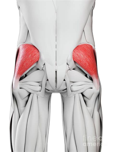 Gluteus Medius Tendonitis