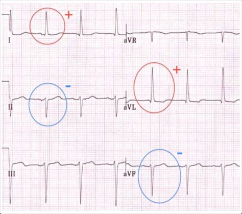 ECG Interpretation