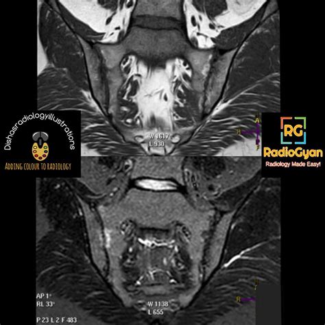 Sacroilitis | Radiology Case | - RadioGyan