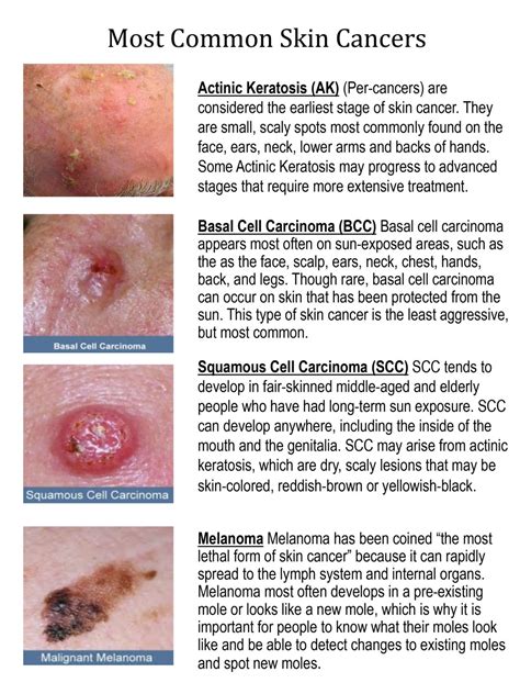 Stages Of Skin Cancer