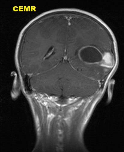 Pleomorphic xanthoastrocytoma (PXA) : MRI - Sumer's Radiology Blog