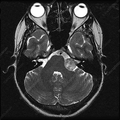 Vestibular Schwannoma, MRI - Stock Image - C039/4308 - Science Photo ...