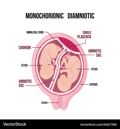 Monochorionic diamniotic twins medical diagram Vector Image