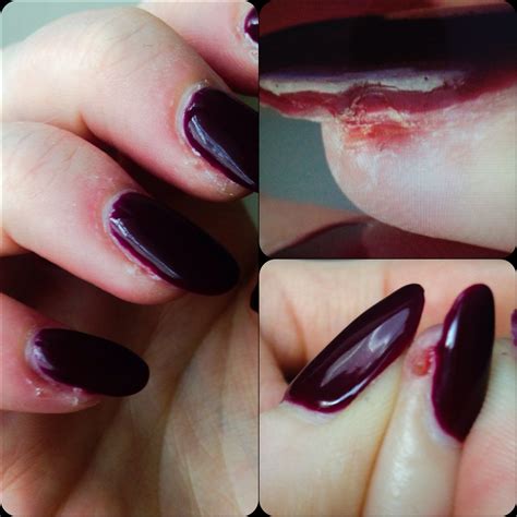 Gel Nail Polish Allergy Symptoms - Nail Ftempo