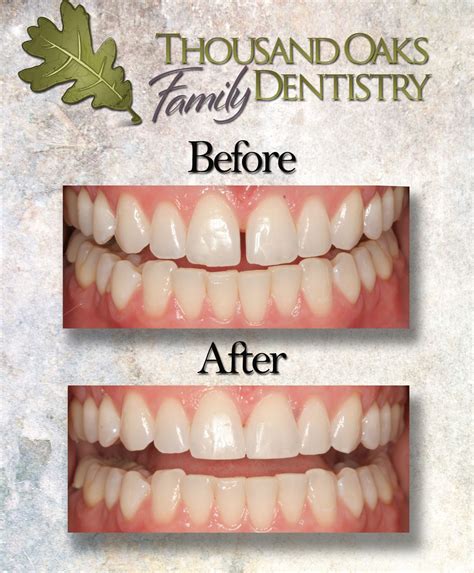 #bonding before and after to close gap between front two teeth # ...