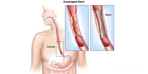 Surgery for Esophageal Cancer