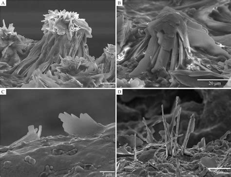 Statins treatment dissolves cholesterol crystals in human plaques. A ...