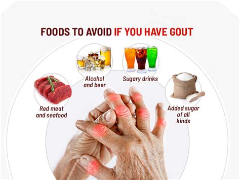 Foods to Avoid with Gout - Shanghai Medical Clinic