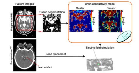 2: Overview of the patient specific electric field simulation workflow ...