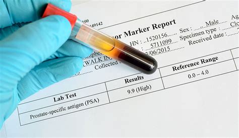 Understanding Elevated PSA Levels and Prostate Cancer | Moffitt