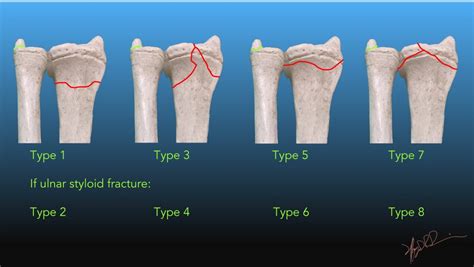 Frykman Classification of Distal Radial Fractures | UW Emergency Radiology