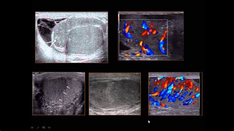 Scrotal Ultrasound - YouTube