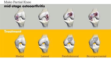 Partial Knee Replacement