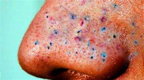 Blackheads - Causes, Treatment and How To Get Rid of Blackheads