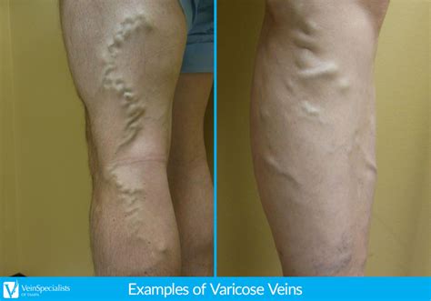 What Causes My Varicose Veins?