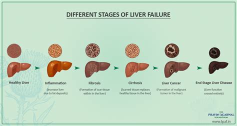 What Are The Different Stages Of Liver Failure?