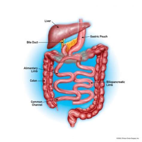 Single Anastamosis Loop Duodenal Switch | WeightWise