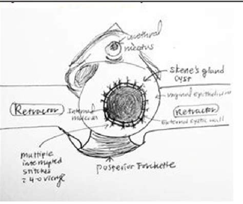 Figure 1 from Marsupialization of Skene ’ s Gland Cyst | Semantic Scholar