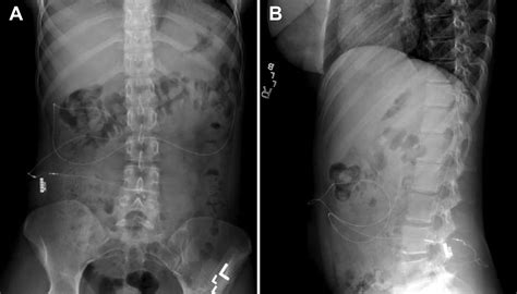 The role of lumboperitoneal shunts in managing chronic hydrocephalus ...